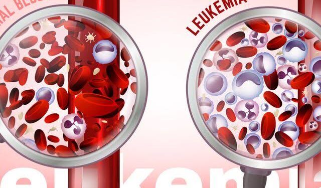 Deteksi Dini Leukemia pada Anak Bantu Kurangi Risiko Kematian