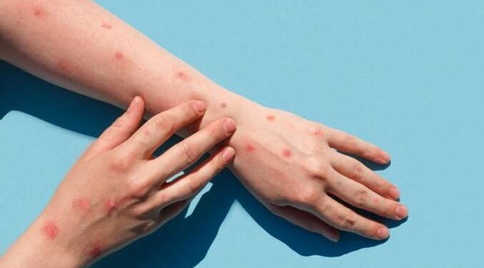 Cacar Monyet di Indonesia Meningkat, Vaksinasi Perlu Diperluas