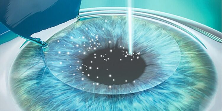 Anda Mau Coba LASIK Mata? Ini Panduan Lengkap dan Tahapannya